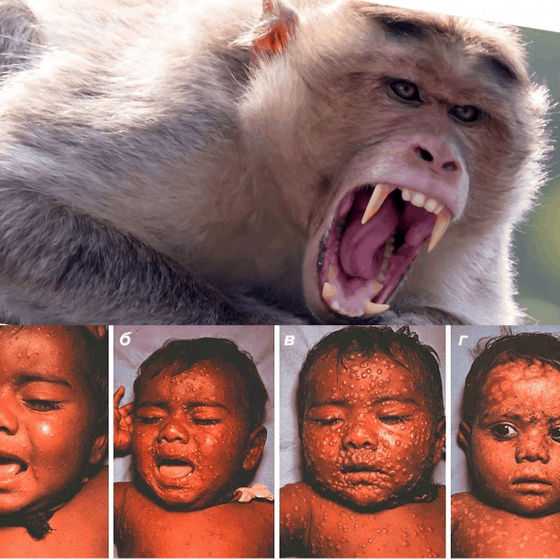 Пандемия оспы обезьян